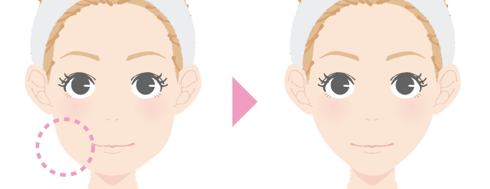 エラボトックスの説明画像