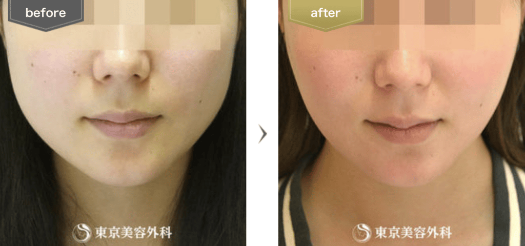 東京美容外科の症例画像