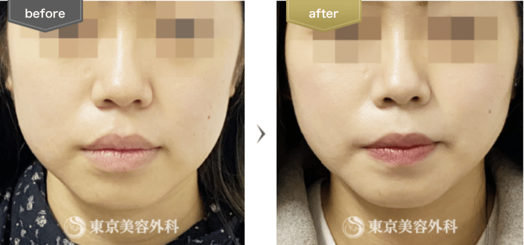 東京美容外科の症例画像
