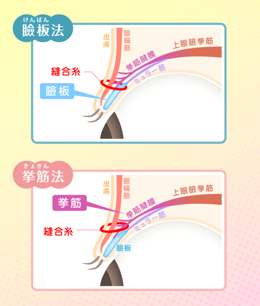 埋没法は糸を留める場所と糸の数が異なる